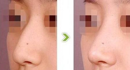 鷹鉤鼻整形要多少錢