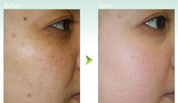 去除黃褐斑的價格一般是多少