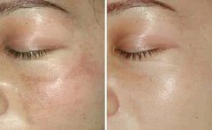 去除黃褐斑的價(jià)格一般是多少