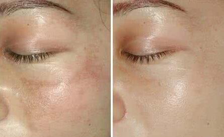 去除黃褐斑的價格一般是多少