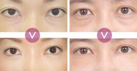 超聲波去眼袋價(jià)格、*果能保持多久