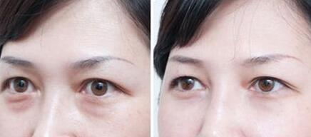 超聲波去眼袋價(jià)格、*果能保持多久