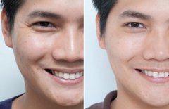 用什么方法能去皺、除皺多少錢