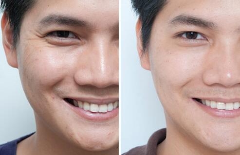 用什么方法能去皺、除皺多少錢