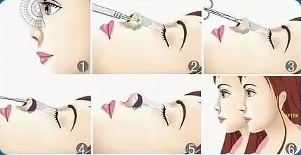 硅膠隆鼻費用是多少？貴嗎？