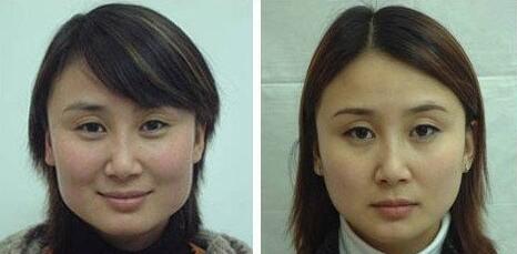 顴骨顴弓,整形,風(fēng)險(xiǎn),注意事項(xiàng)