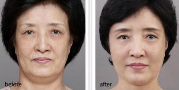 *,去皺,多少錢,注意事項(xiàng)