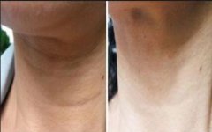 頸紋怎么消除*？那種方法好？