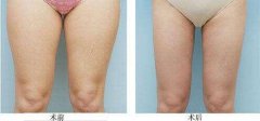 大腿抽脂多久恢復(fù)正常不痛，多久見(jiàn)？