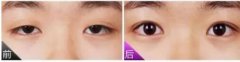 上瞼提肌手術(shù)有必要嗎？不做有什么危害？