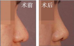 自體軟骨隆鼻是*的嗎？有哪些優(yōu)勢？