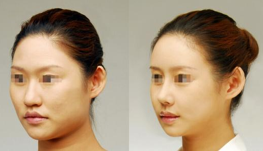 膨體隆鼻可以*嗎？有哪些注意事項？