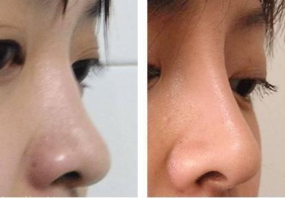 隆鼻后多久山根會(huì)自然？*果能保持多久？