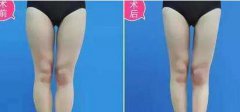 大腿吸脂后多久開始瘦？多久恢復(fù)？