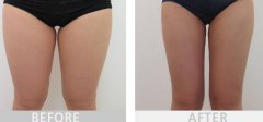 大腿吸脂3500能瘦多少？多久開始瘦？