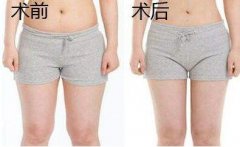 大腿吸脂有幾個切口？大腿環(huán)吸幾個切口？
