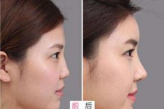 隆鼻手術(shù)3天拆了會歪嗎？歪了怎么辦？