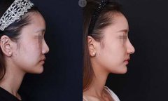 膨體隆鼻是*的嗎？多久恢復(fù)？