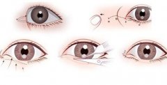 開眼角失敗怎么辦？有疤怎么辦？