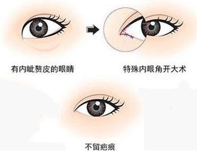 韓式*開眼角價格