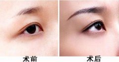 種植眉毛的適合人群有哪些？眉毛種植果圖？