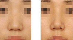 做了隆鼻手術(shù)后的護(hù)理，具體注意事項(xiàng)