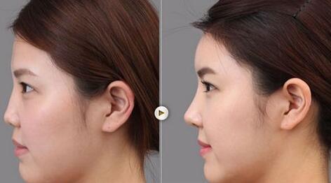 做了隆鼻手術(shù)后的護(hù)理，具體注意事項(xiàng)