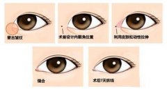 開眼角手術(shù)風(fēng)險(xiǎn)大嗎？如何規(guī)避？