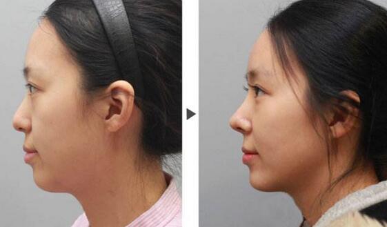 隆鼻術(shù)前注意，術(shù)前準(zhǔn)備有哪些