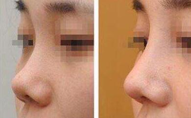 隆鼻術(shù)前注意，術(shù)前準(zhǔn)備有哪些