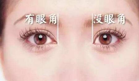 開眼角恢復(fù)時(shí)間要多久？多久恢復(fù)自然？