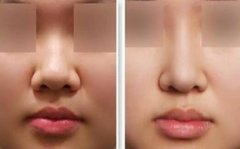 隆鼻固定膠帶幾天去掉?多久可以撕?