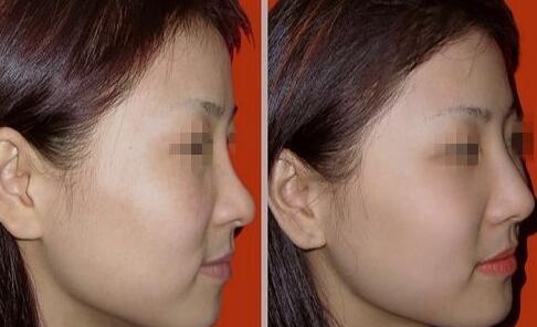 隆鼻以后怎么恢復(fù)快，術(shù)后如何護(hù)理?