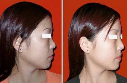 隆鼻以后怎么恢復(fù)快，術(shù)后如何護(hù)理?