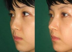 隆鼻手術(shù)恢復(fù)要多久，幾天恢復(fù)自然?