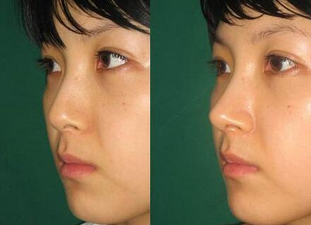 隆鼻手術恢復要多久，幾天恢復自然?