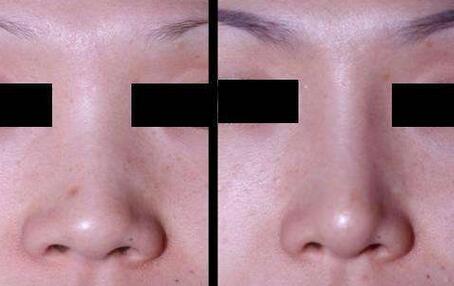 隆鼻手術恢復要多久，幾天恢復自然?