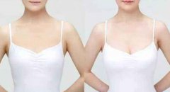 假體豐胸術(shù)后恢復(fù)注意事項(xiàng)？假體豐胸后需要注意哪些？