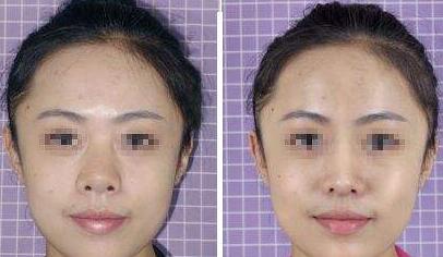 北京膨體隆鼻價(jià)格是多少？膨體隆鼻手術(shù)多少錢(qián)？