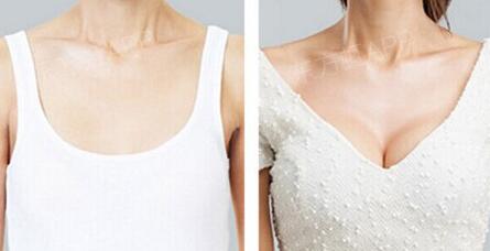 假體豐胸多久就不痛了，假體豐胸多久能恢復？