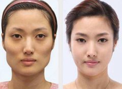 磨顴骨多少錢(qián)？磨顴骨危險(xiǎn)嗎？