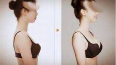 娜琦麗假體隆胸多少錢？娜琦麗假體多久變軟？