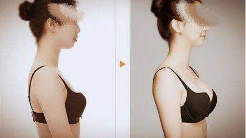 娜琦麗,假體隆胸,多少錢,多久變軟