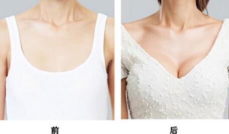 假體豐胸能保持多久，假體豐胸*果可以維持多久？