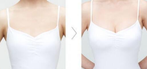 假體豐胸危害有哪些？假體豐胸有副作用嗎？