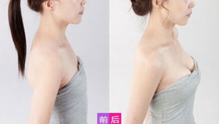 威寧假體豐胸怎么樣？威寧假體豐胸*果如何？