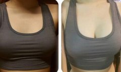 假體豐胸信息介紹？如何選醫(yī)院？