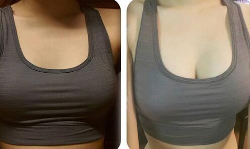 假體豐胸信息介紹？如何選醫(yī)院？