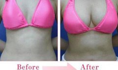 妙桃假體豐胸費(fèi)用？妙桃假體大概多少錢(qián)？