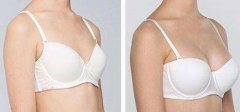 假體豐胸手術(shù)費(fèi)用是多少？假體豐胸多少錢(qián)？